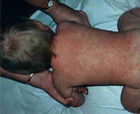 Причины возникновения аллергической сыпи у детей и методы лечения высыпаний