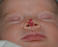 Красное пятно у новорожденного гемангиома