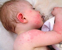 Причины атопического дерматита в детском возрасте. Методы лечения