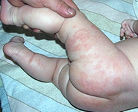 Пеленочный дерматит — как вылечить нежную кожу ребенка