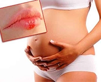 Какую опасность несет герпес на губах при беременности и как его лечить