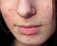 Почему появляется сыпь на лице у взрослого, способы ее лечения