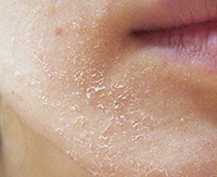 Причины возникновения и лечение шелушения кожи на локтях и теле