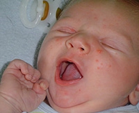 Сыпь на лице у новорожденного: почему появляются прыщики и как их лечить