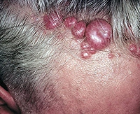 Виды базально-клеточного рака кожи и методы лечения