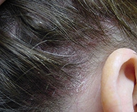 Действенное избавление от псориаза волосистой части головы