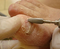Микоз ногтей на ногах: причины, признаки грибка и способы лечения