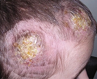 Причины возникновения, симптомы и лечение микоза кожи головы