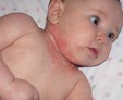 Пузырчатка новорожденных — как избавить малыша от инфекционного заболевания?