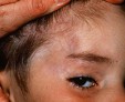 Что такое атрофия кожи и как проводится ее лечение?