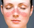 Экзема на лице: проявления и особенности лечения в зависимости от клинической формы