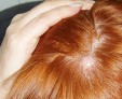 Атерома волосистой части головы: методы лечения у детей и взрослых