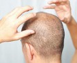 Причины, разновидности и способы лечения фолликулита на голове