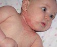 Нужен ли поход к дерматологу, если у ребенка красная сыпь на теле