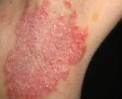 Виды кандидоза кожи и лечение этого грибкового заболевания