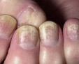 Грибок ногтей:  подбираем лечение с учетом вида возбудителя 