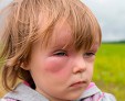 Отек Квинке - опасная аллергическая реакция у детей