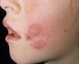 Виды вирусных заболеваний кожи и их последствия
