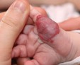 Как избавиться от рожистого воспаления на руке