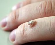 Как вывести шипицу на пальце руки: медикаментозное и домашнее лечение