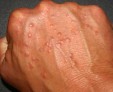 Как быстро очистить кожу на руках от прыщей