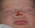 Причины возникновения гемангиомы у новорожденного и стоит ли бить тревогу