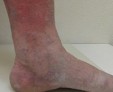 Особенности лечения дерматита кожи на ногах