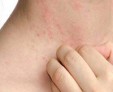 Причины и лечение гладкой кожи от кандидоза
