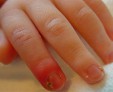 Панариций пальца на руке — эффективное лечение нарыва на пальце в домашних условиях