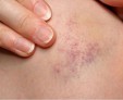Тромбоцитопеническая пурпура: лечение у детей и взрослых болезни Верльгофа