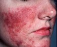 Опасна ли гиперемия кожи: эффективное лечение и методы профилактики