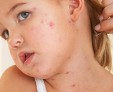 Инфекционные и неинфекционные заболевания кожи у детей: симптомы, описание