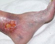 Быстрое и эффективное лечение трофической язвы на ноге