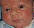 Что делать, если у новорожденного появилась сыпь на коже?