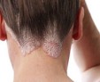 Сухая себорея кожи головы: причины развития и лечение себорейного дерматита
