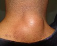 Причины появления липомы на шее и методы лечения новообразования