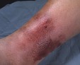 Как и чем лечить рожистое воспаление кожи ноги?