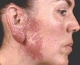 Как выглядит туберкулез кожи, как диагностировать и как лечить заболевание?