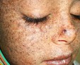 Пигментная ксеродерма: риски развития онкопатологии кожи и продолжительность жизни 