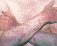 Пустулезный (экссудативный) псориаз: лечение тяжелой формы заболевания