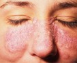 Как и чем очистить кожу от псориаза на лице?