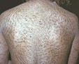 Формы проявления ихтиоза кожи и методы лечения заболевания