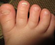 Почему появляется грибок ногтей на ногах у детей и как его лечить