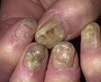 Как определить и вылечить грибок ногтей на руках?