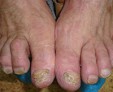 Грибок ногтей — эффективные методы лечения онихомикоза в домашних условиях