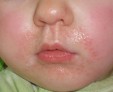 Как проявляется и лечится пероральный дерматит у ребенка