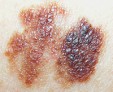 Что такое меланома кожи и лечение злокачественного новообразования