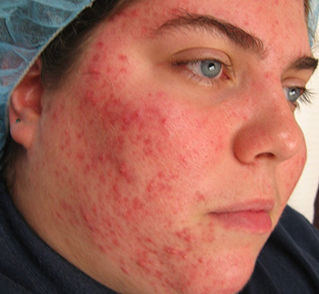 Угревая сыпь в подростковом возрасте может появляться на разных участках кожи, но чаще всего этот дефект наблюдается на лице, а также в области груди и спины
