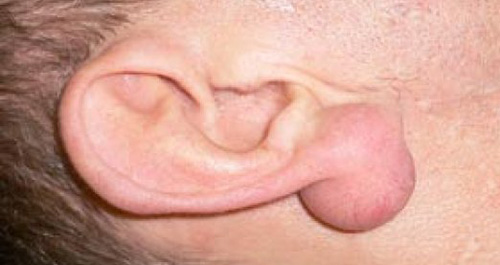 Атерома мочки уха