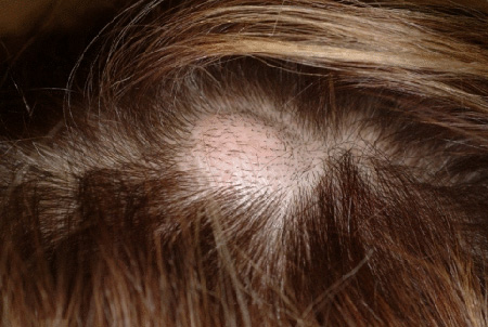 Жировик волосистой части головы